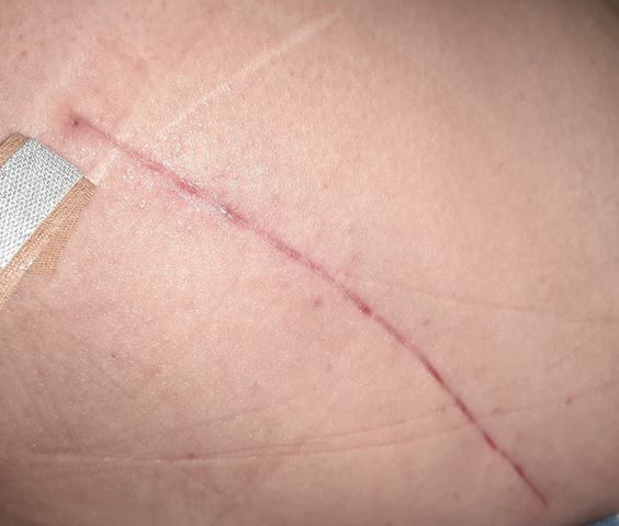 wound healing